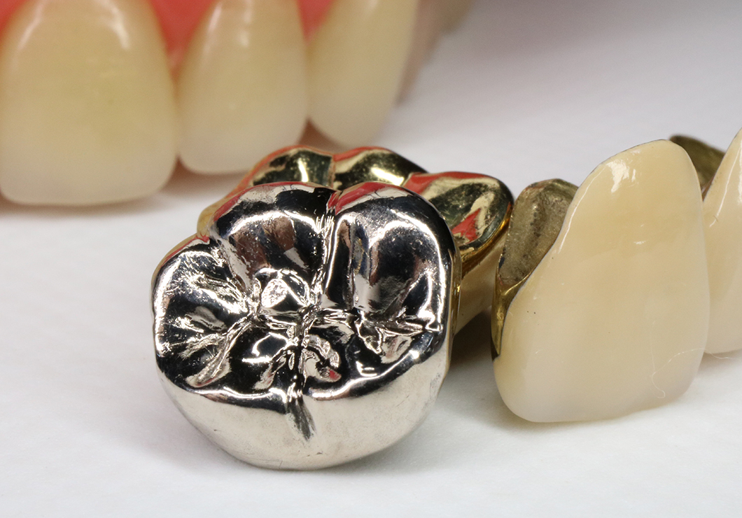 金属アレルギーのリスクを軽減